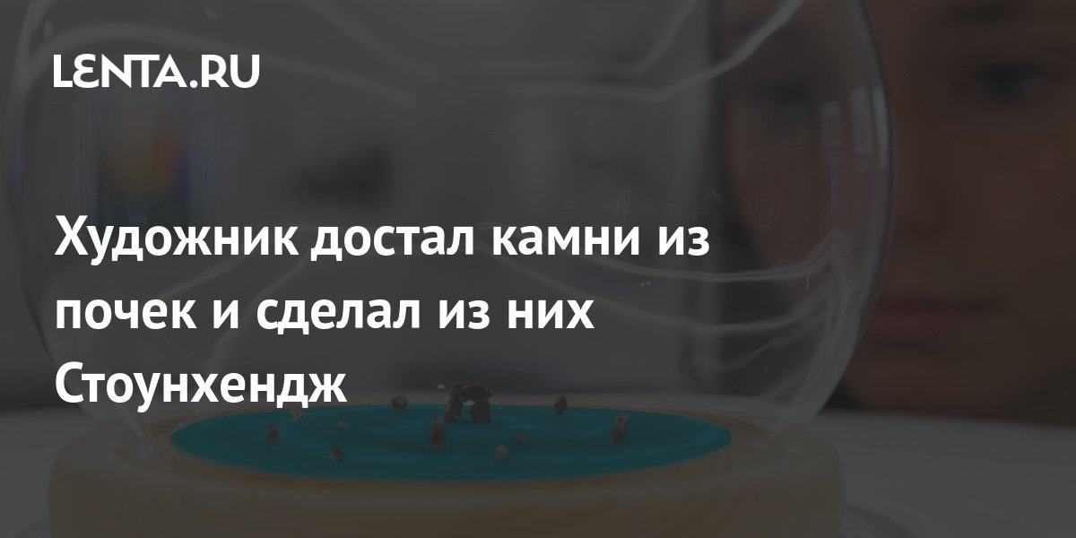 Как выходят камни из почек у женщин в картинках