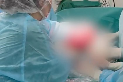 Опухоль размером с живот беременной женщины нашли в теле россиянки
