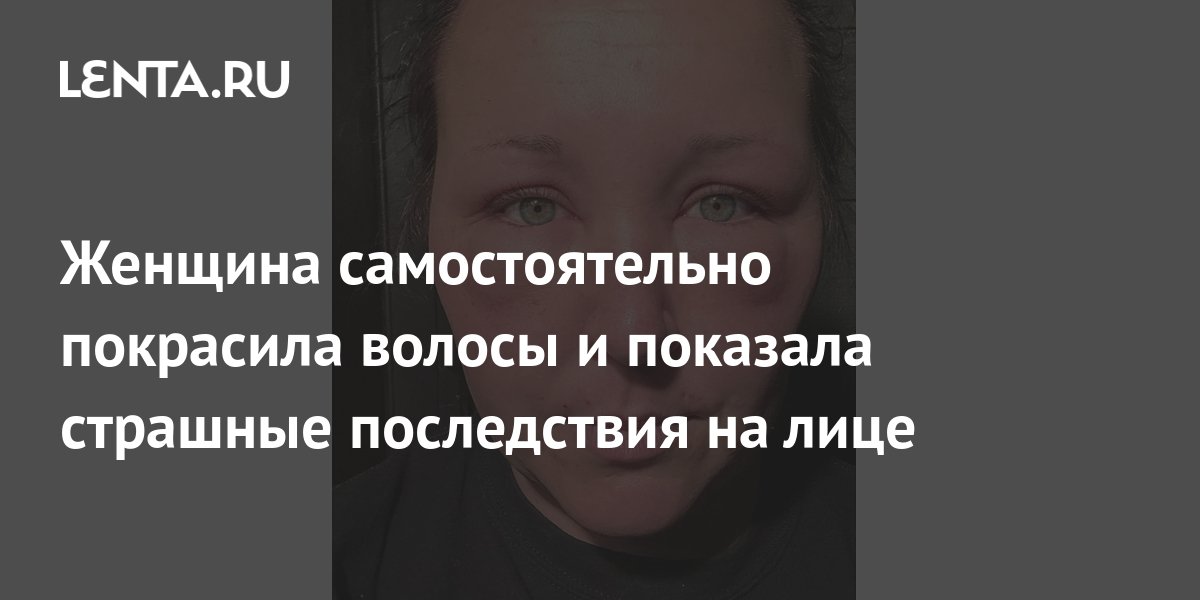 Женщина самостоятельно покрасила волосы и показала страшные последствия ...