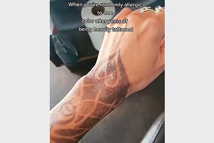 Девушка показала страшные последствия аллергии на татуировку