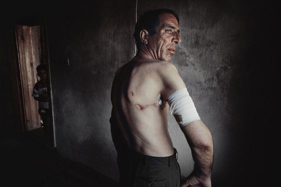 Неизвестный мужчина показывает свои шрамы после резни в своем родном городе Сува-Река, Косово, дата неизвестна
