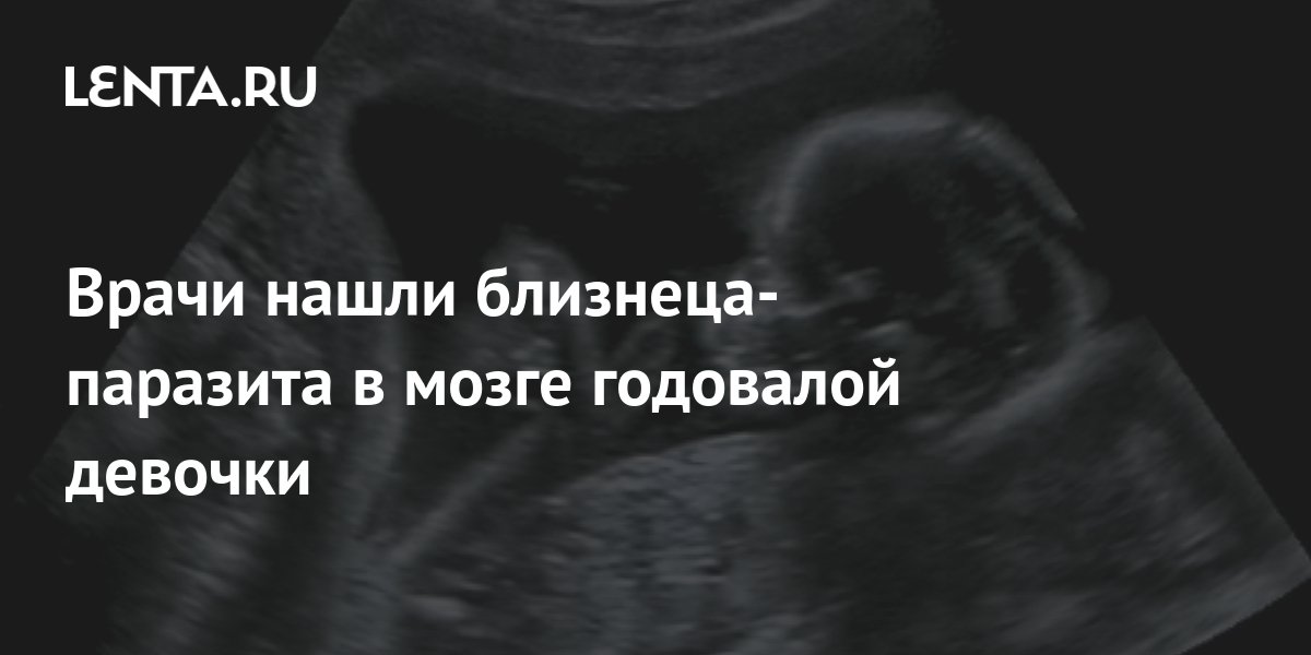 Новорожденный оказался «беременным» собственным близнецом — как это вышло
