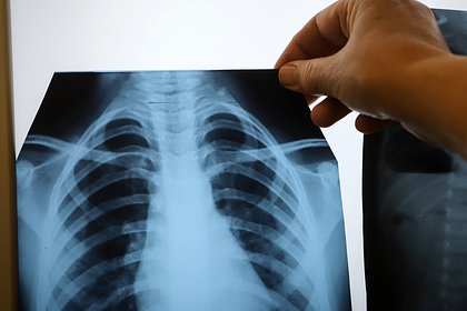 Россиянам назвали условие заражения туберкулезом