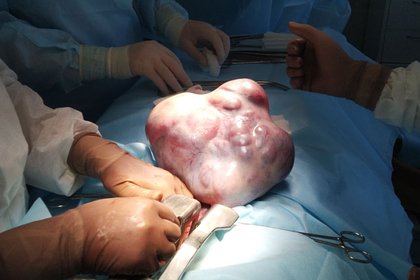 В яичнике 14-летней россиянки выросла опухоль весом с новорожденного ребенка