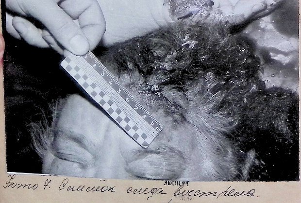 Огнестрельное ранение на голове Валерии Зарубиной. Из материалов уголовного дела