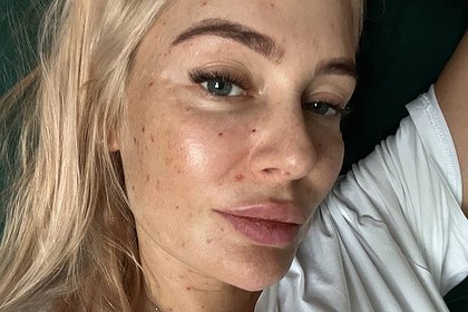 Актриса Рудова показала лицо без фильтров со следами от инъекций