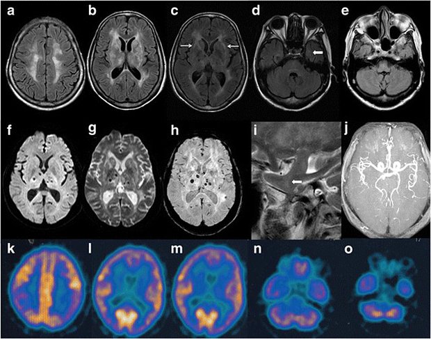 Снимки мозга пациента с диагнозом «фатальная семейная бессонница»