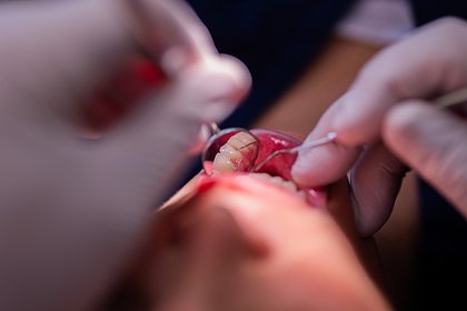 Российский стоматолог-любитель лишил пациента здорового зуба