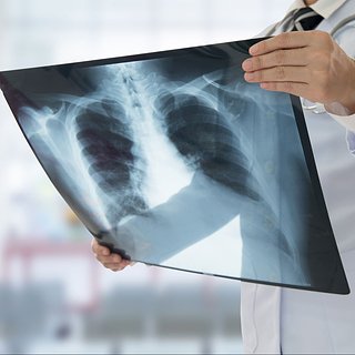 Обнаружена причина распространения устойчивого к лечению туберкулеза