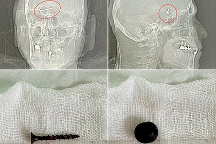 В черепе россиянина нашли саморез и шарик