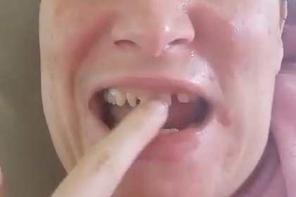 34-летняя женщина лишилась зубов из-за необычной болезни