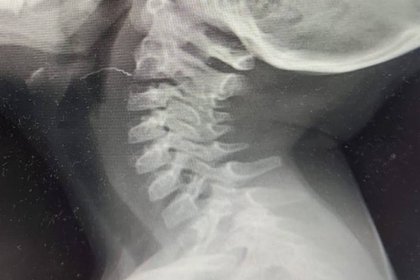 Двухлетняя девочка из Подмосковья неделю провела с проволокой в горле