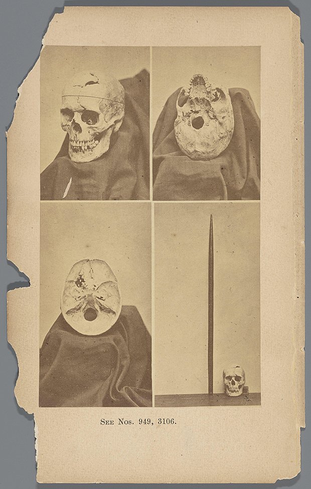 Four views of the skull of Phineas Gage, Anonymous, 1868 photograph United States of America photographic support albumen print (human) skull. infections and wounds