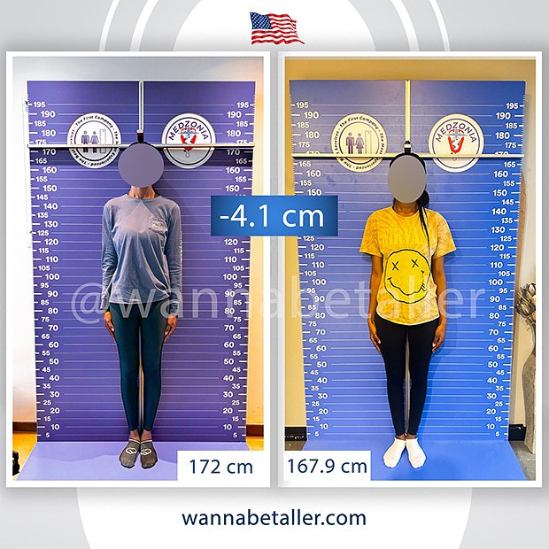 Our patient in her 20s, who came from Europe, has completed her femur shortening surgery process. She achieved a reduction of 4.1 cm. We wish our patient completing  the process, a healthy recovery. 
Pre-Op Height: 172 cm
Post-Op Height: 167.9 cm