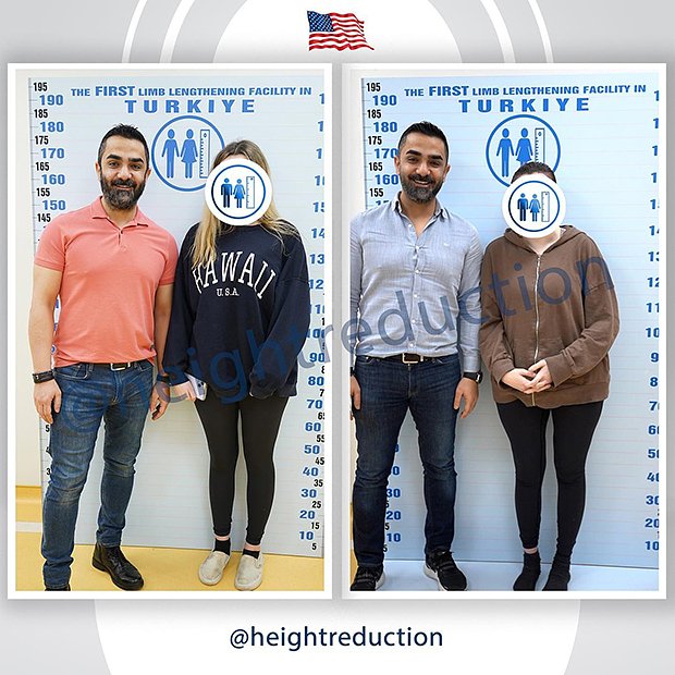 Our American's height, which used to be 173 cm, has become 168.1 cm after she had her limb reduction surgey from femur and shortening 4.9 cm.

Pre-Surgery Height: 173 cm
Post-Surgery Height: 168.1 cm

Boyu 173cm olan Amerikalı kadın hastamız boy kısaltma ameliyatı sonrası femurdan 4.9cm kısalarak 168.1cm olmuştur. 