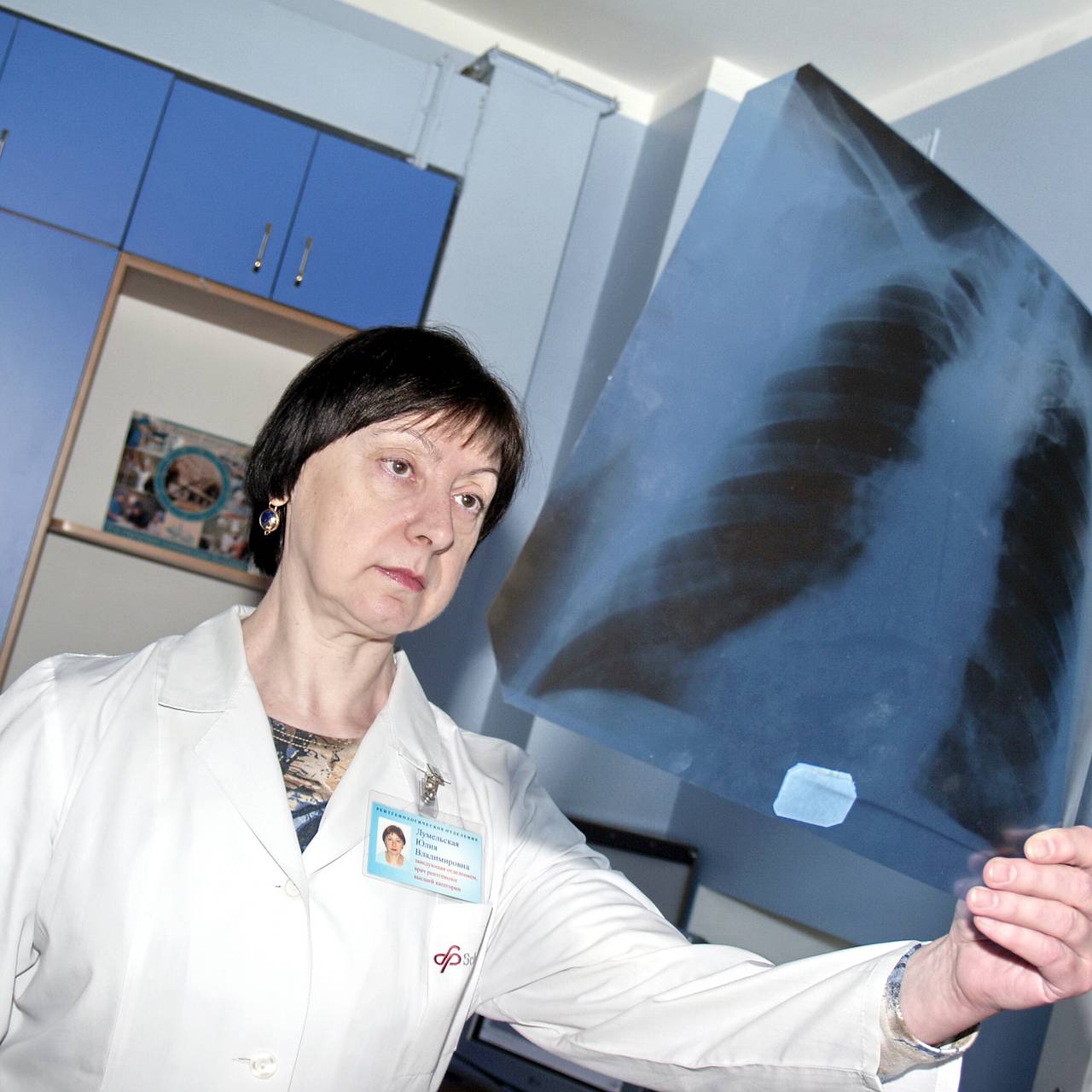 Россиянам перечислили главные симптомы пневмонии