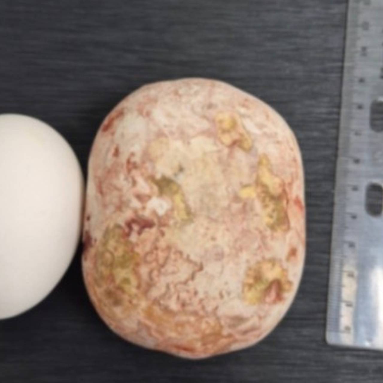 Гигантский камень извлекли медики из россиянина