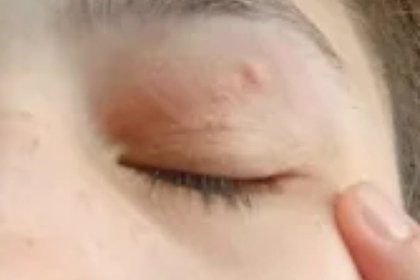 Из глаза девушки удалили 11-сантиметрового червя