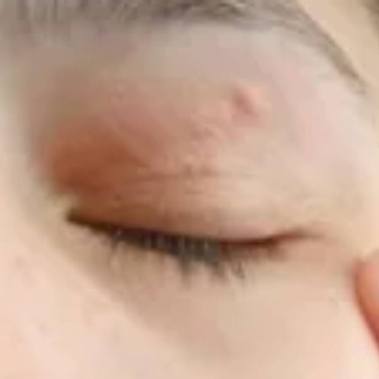 Из глаза девушки удалили 11-сантиметрового червя