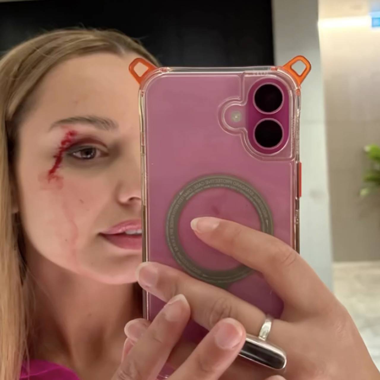 Репортер пережила нападение птицы во время съемок и показала лицо в крови