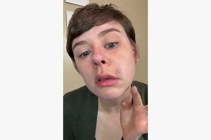 Женщина выдавила прыщ в &laquo;треугольнике смерти&raquo; и осталась с перекошенным лицом