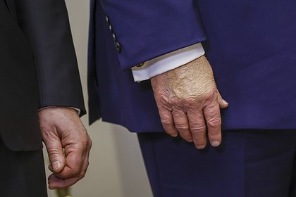 Трамп скрыл синяк перед встречей с Зеленским