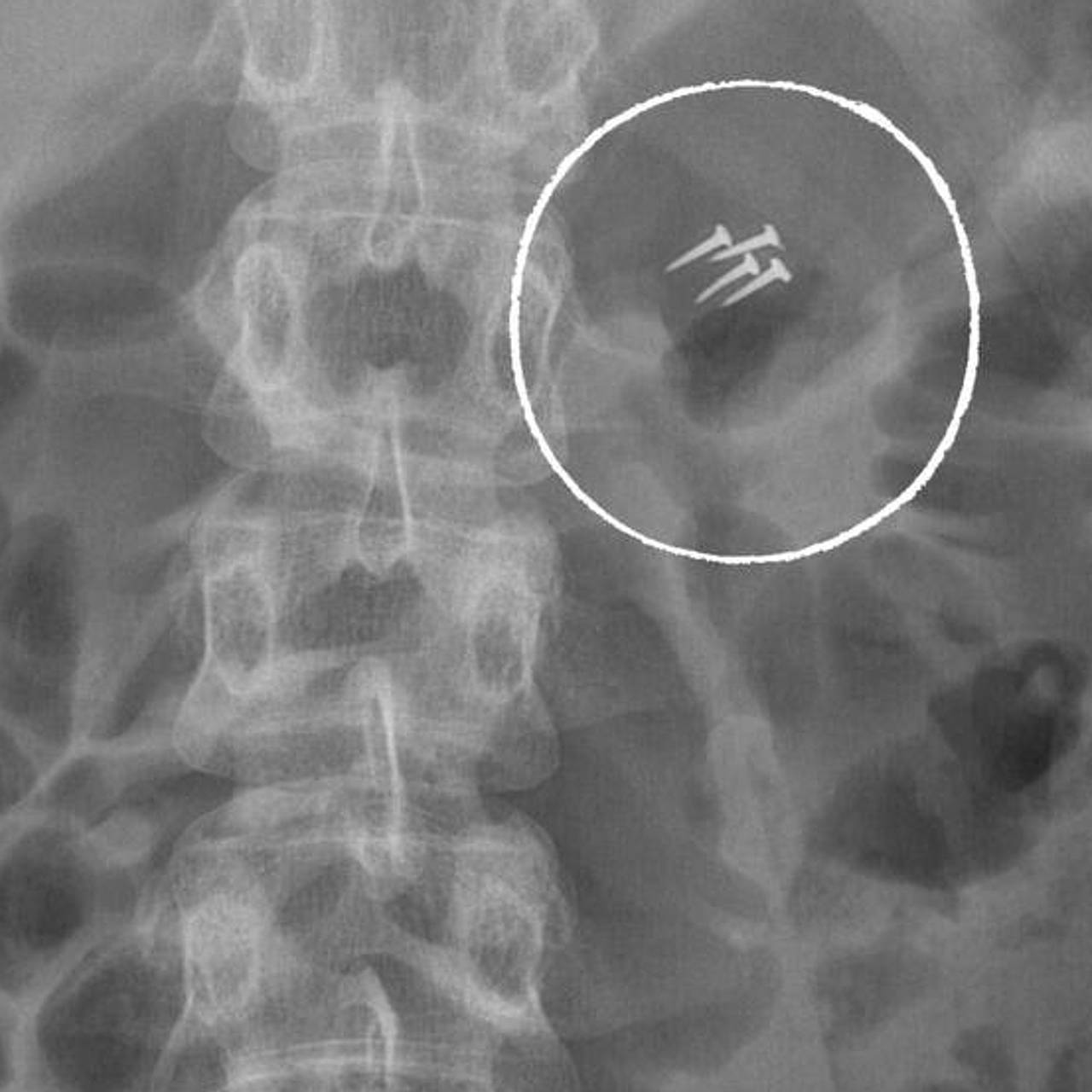 Врачи Склифа показали самые необычные находки в пациентах