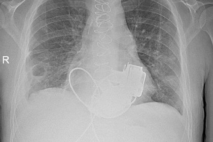 Уникального пациента без пульса выпишут из российской больницы