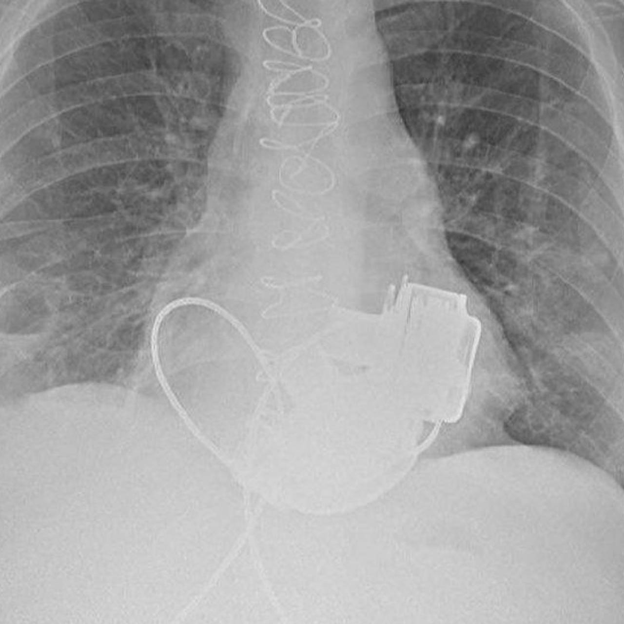 Уникального пациента без пульса выпишут из российской больницы