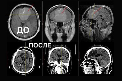 Россиянин упал на улице и узнал об опухоли размером с теннисный мяч у себя в мозге