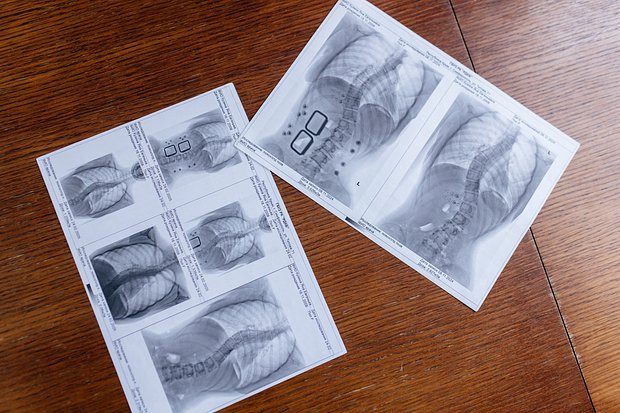 «Мне поможет только операция, врача я уже нашла» Без срочного хирургического лечения Яну ждет тяжелая инвалидность. Нужна помощь