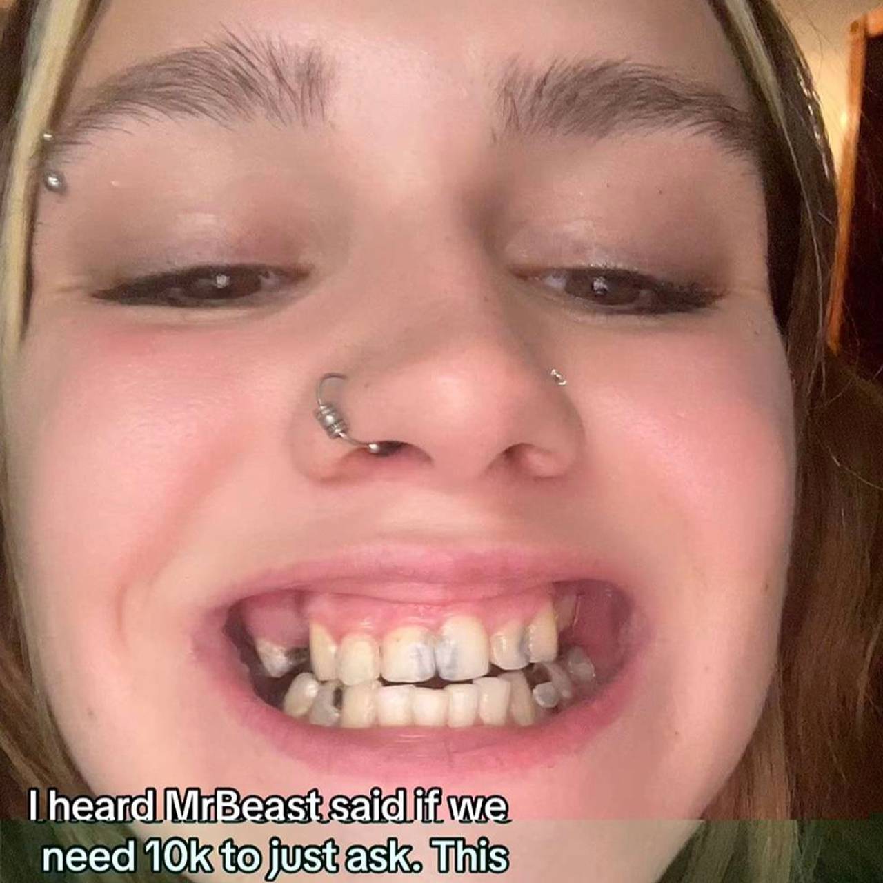 23-летняя блогерша останется без всех зубов из-за одной причины