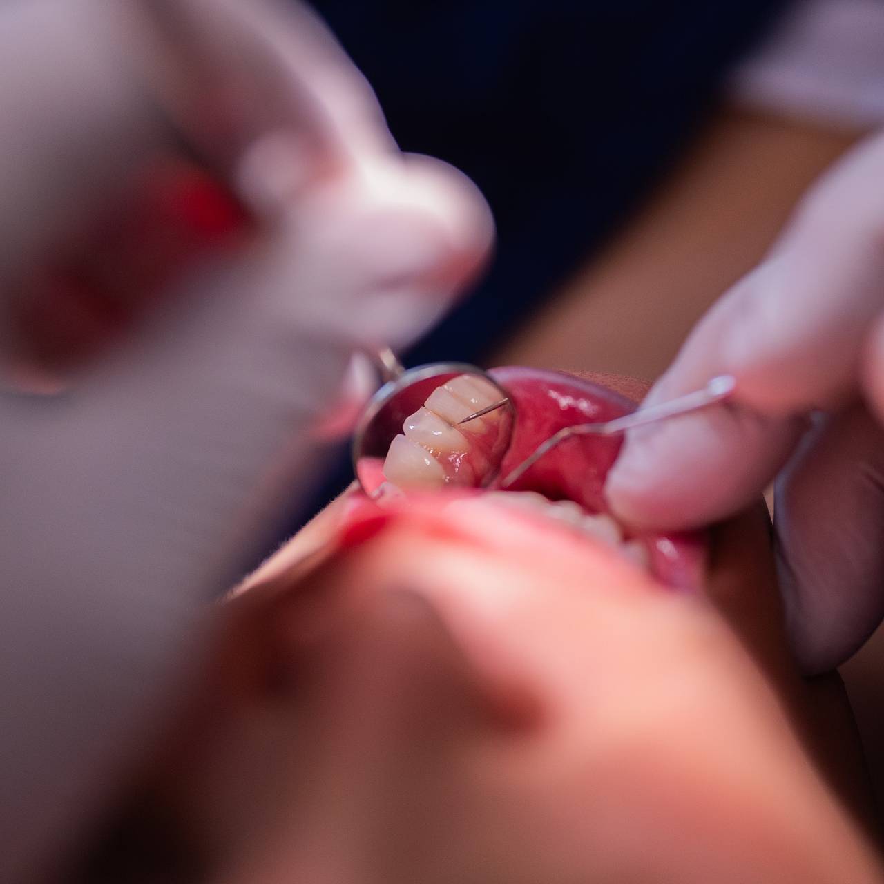 Названы самые бесполезные процедуры в кабинете стоматолога