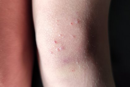 Россиян предупредили о риске заразиться коварной инфекцией в общественных местах