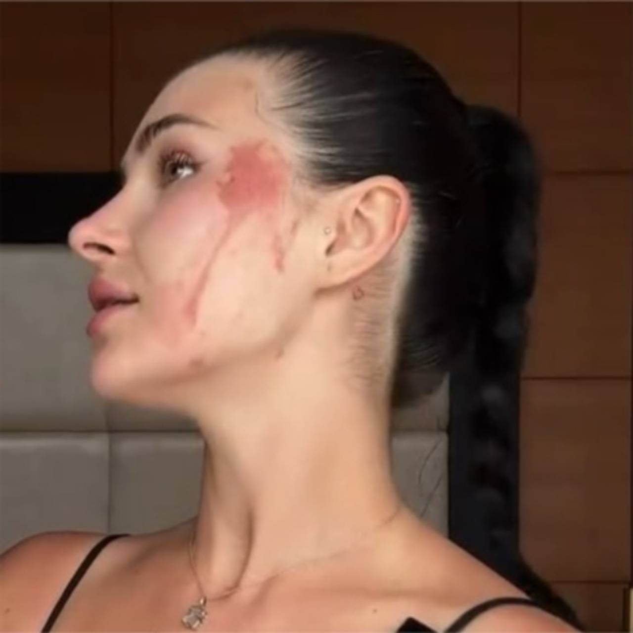 Блогерша показала страшные последствия попадания на кожу яда насекомого