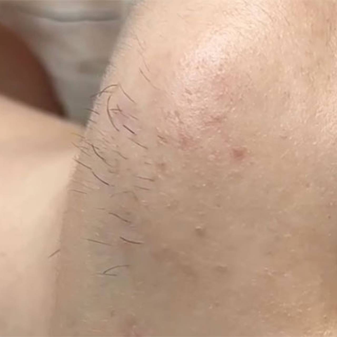 Россиянка показала выросшие на лице волосы после лазерной эпиляции