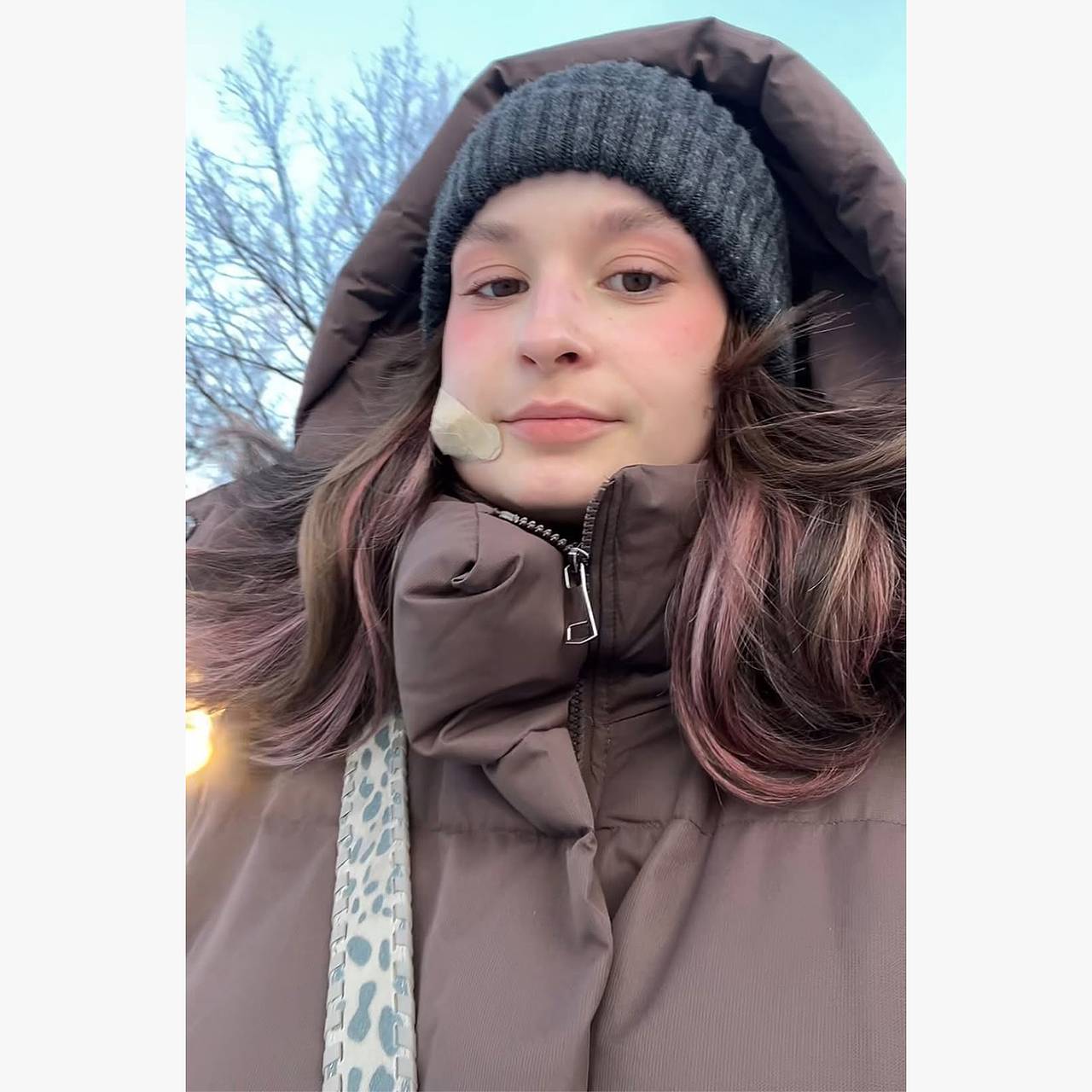 Блогерша выдавила прыщ на лице и едва не лишилась жизни