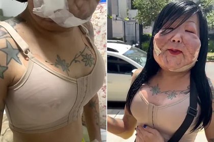 Врач показал грудь блогерши с изуродованным лицом после увеличения