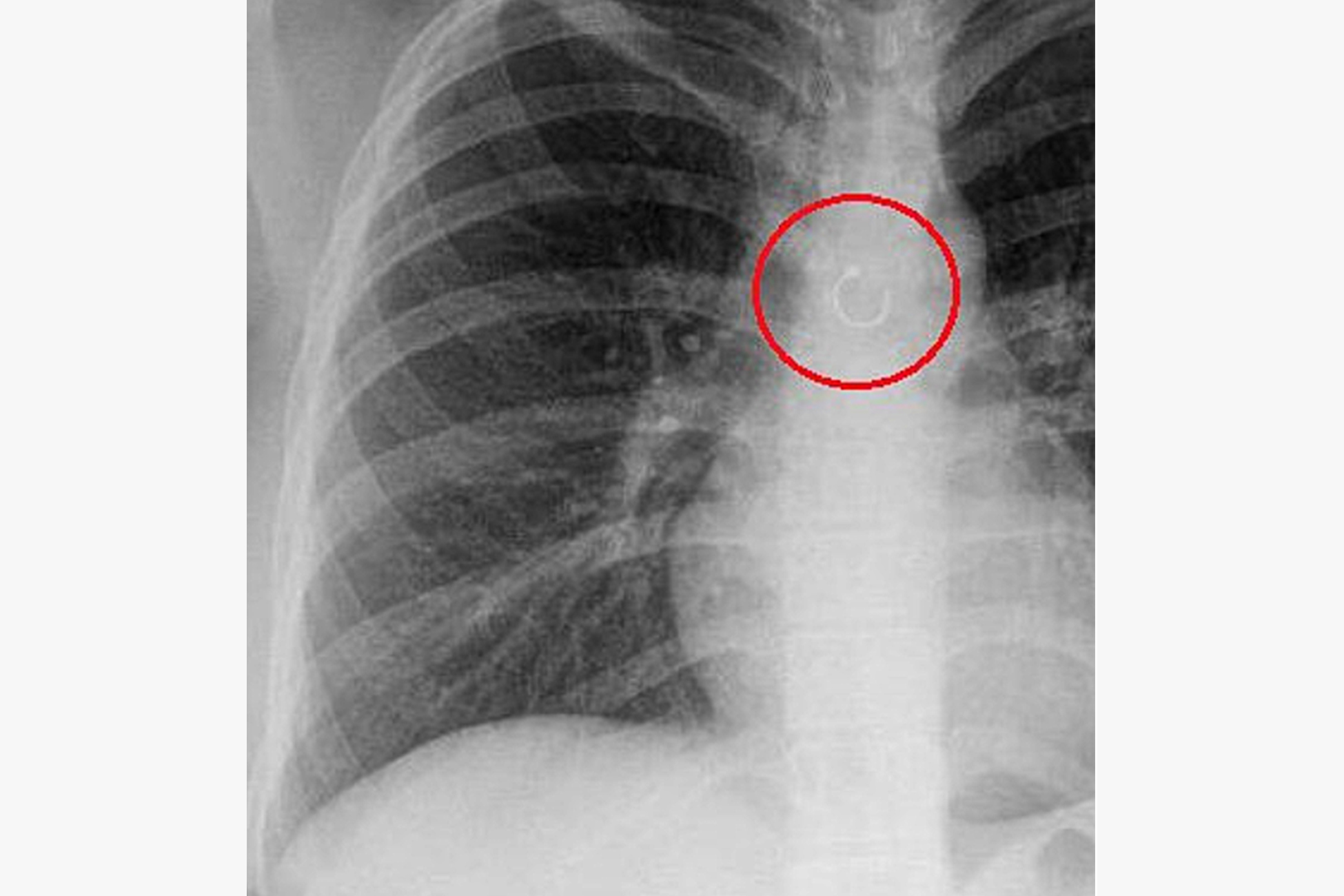 В&nbsp; легком у девушки нашли пирсинг носа