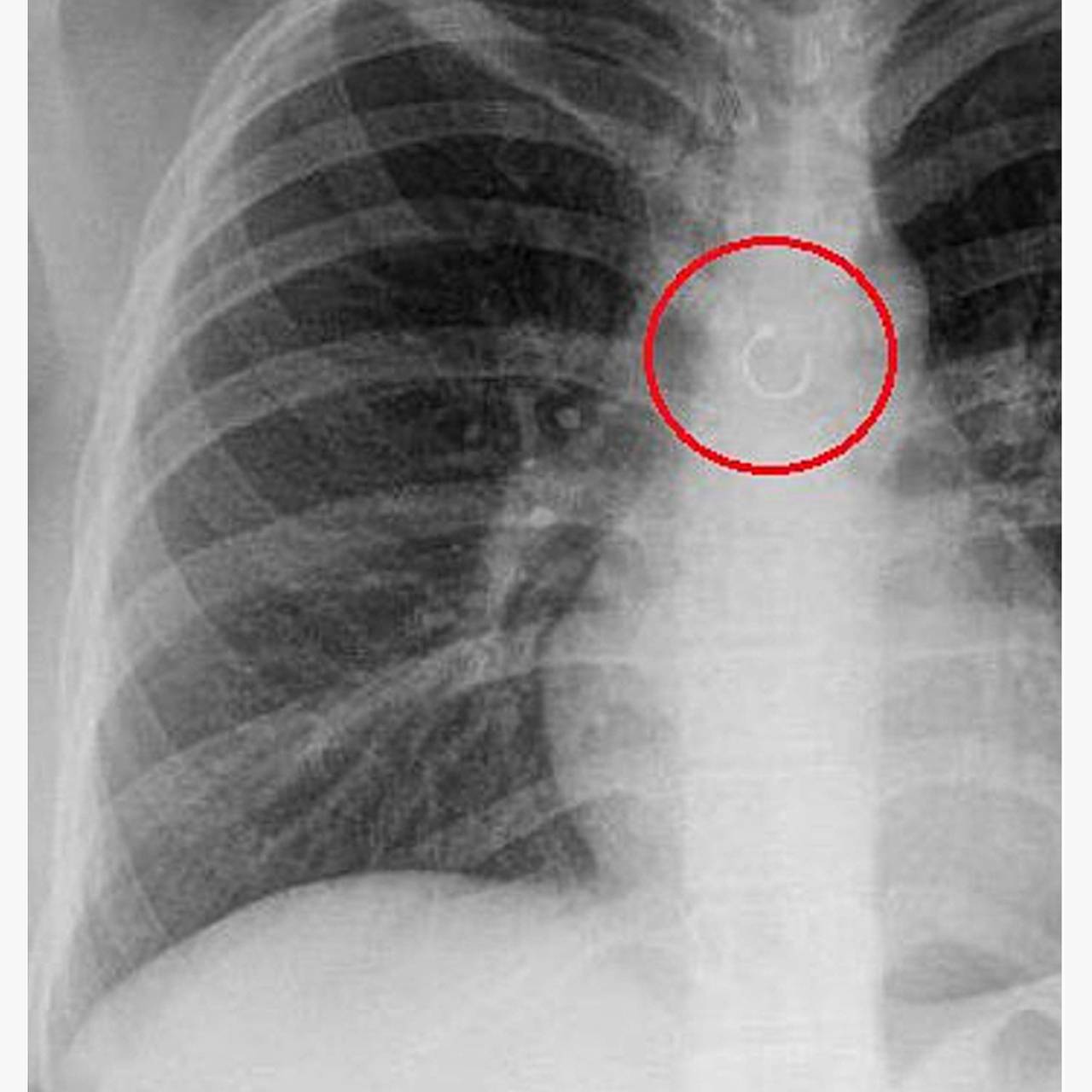 В легком у девушки нашли пирсинг носа