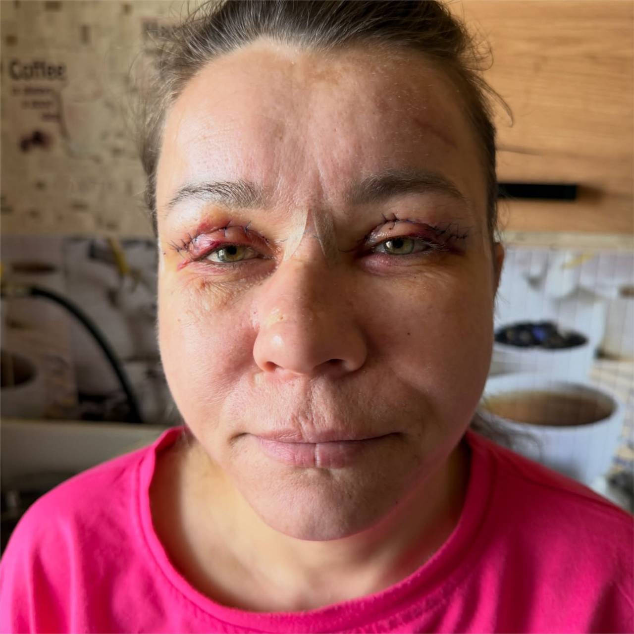 Треш-блогерша Иришка Чики-Пики сделала пластику