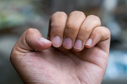 Назван проявляющийся на кончиках пальцев симптом рака легких