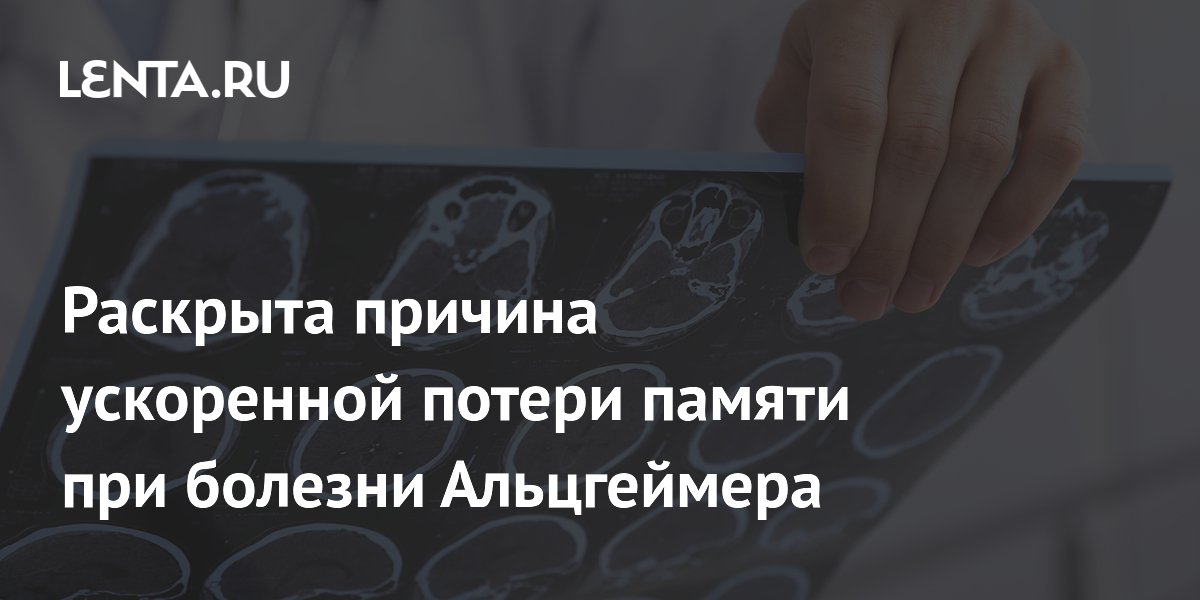 Раскрыта причина ускоренной потери памяти при болезни Альцгеймера