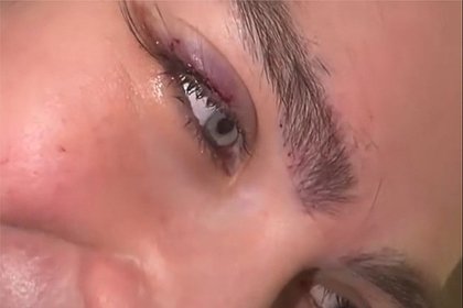 В сети удивились внешности клиентки после пересадки ресниц