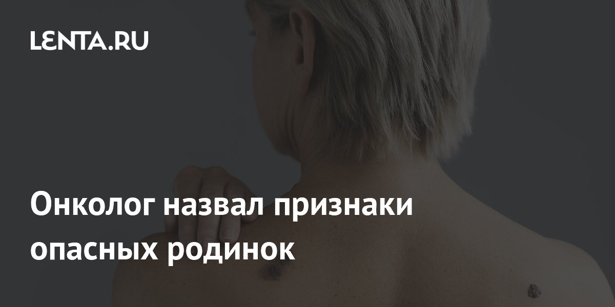 Онколог назвал признаки опасных родинок