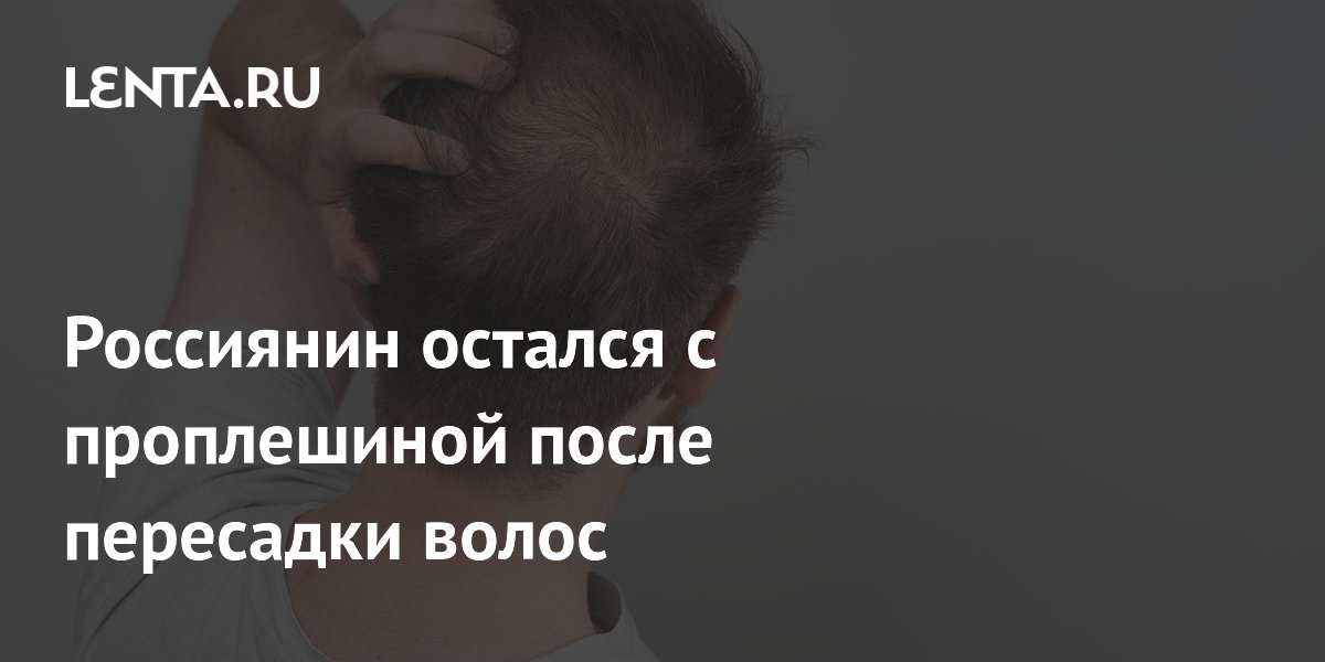 Россиянин остался с проплешиной после пересадки волос