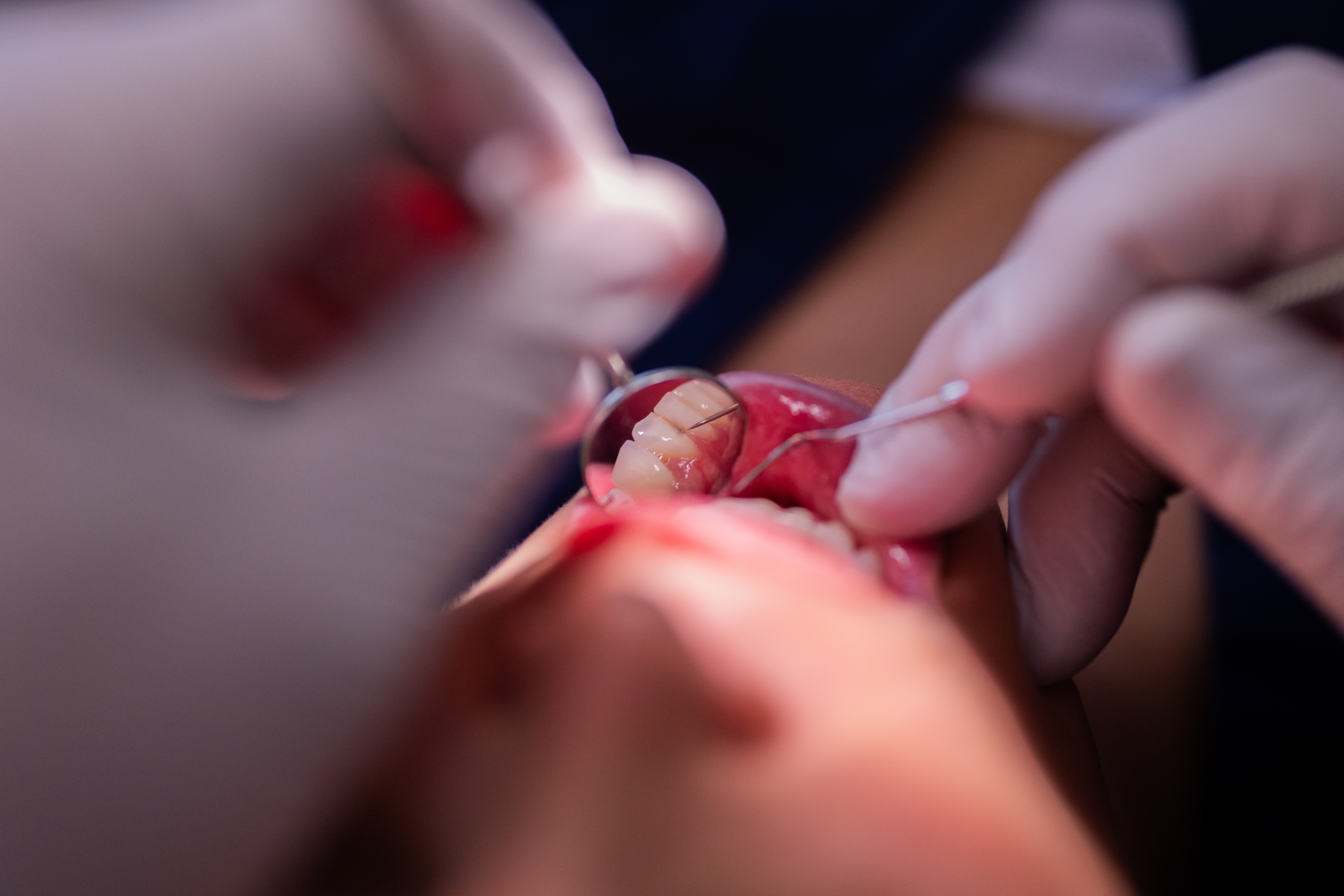 Bleeding Gums Linked to Higher Risk of Type 2 Diabetes